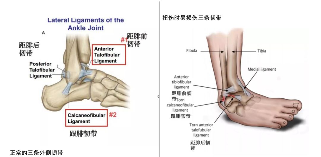 必须收藏：急性外侧踝关节扭伤最新指南解读！