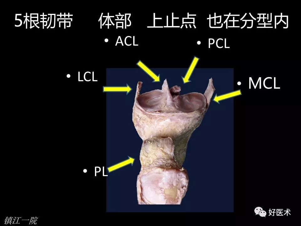 胫骨平台骨折的四柱九区分型法，更准确易懂！