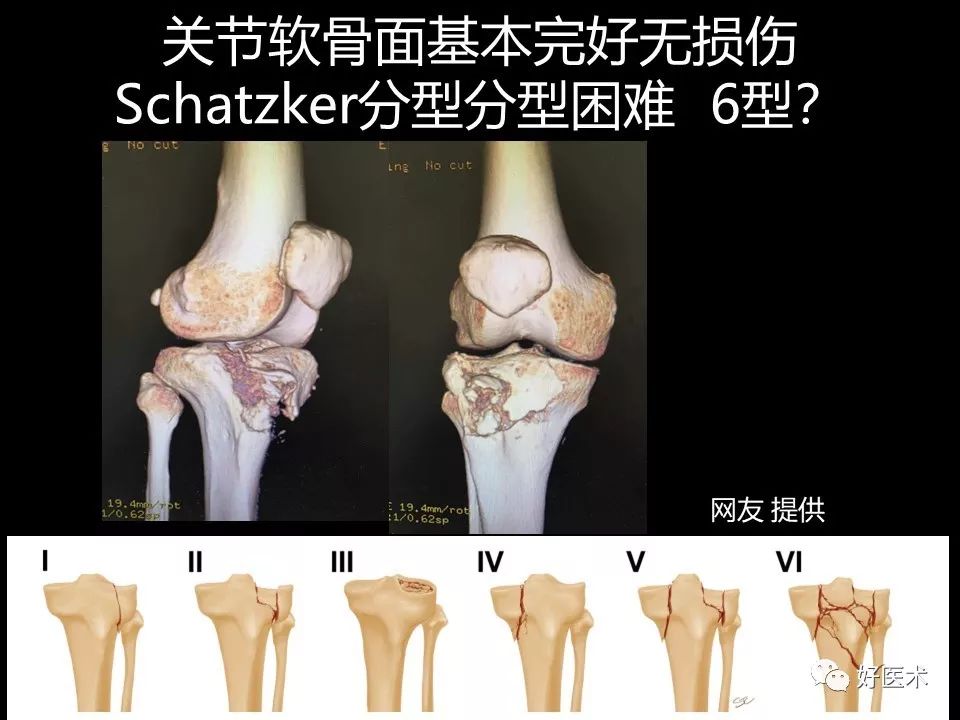 胫骨平台骨折的四柱九区分型法，更准确易懂！