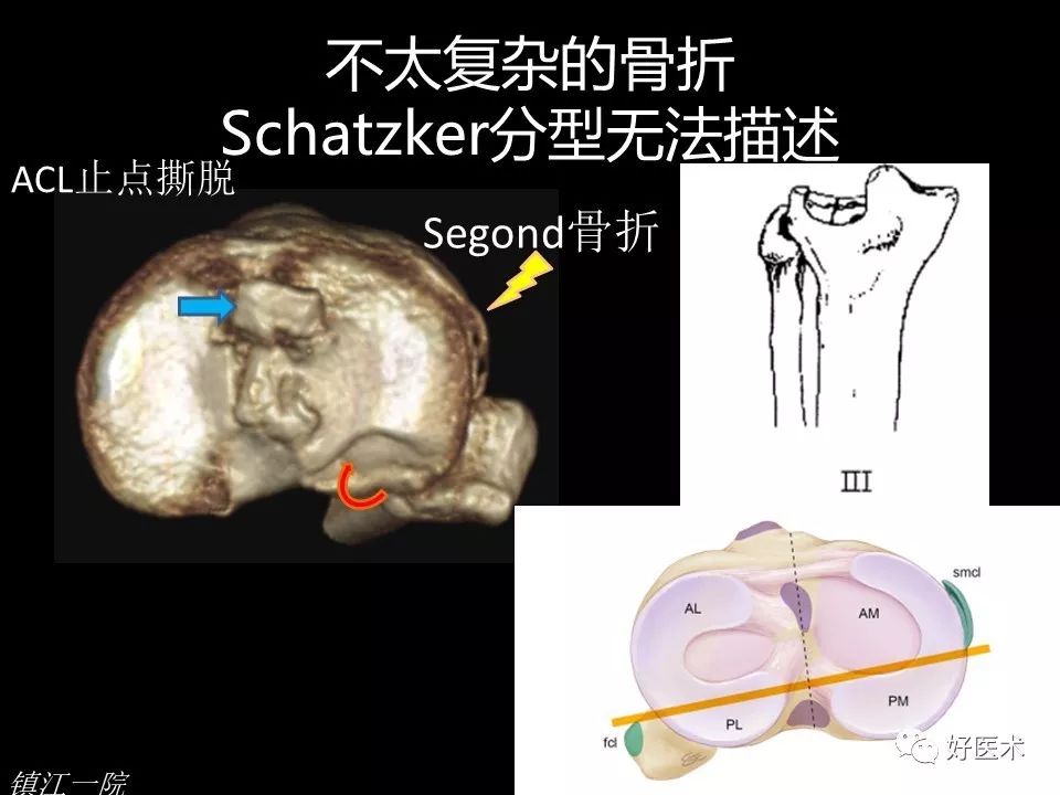 胫骨平台骨折的四柱九区分型法，更准确易懂！