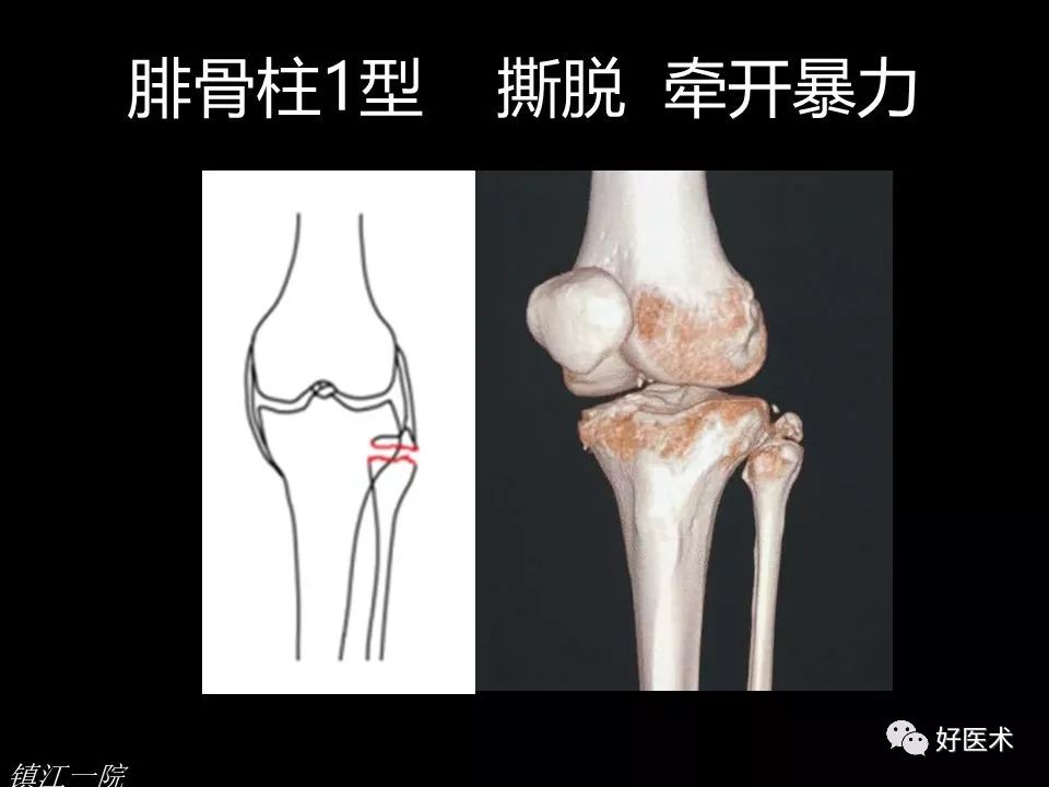 胫骨平台骨折的四柱九区分型法，更准确易懂！