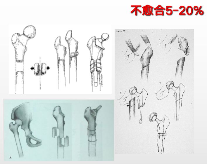 髋关节脱位快速诊治的关键技巧，此文必看！