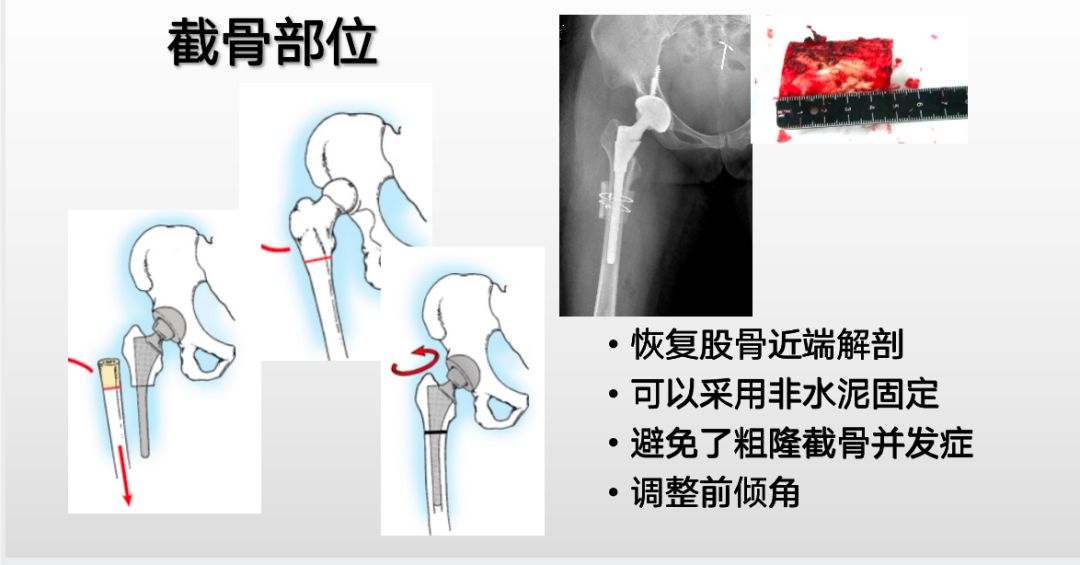 髋关节脱位快速诊治的关键技巧，此文必看！