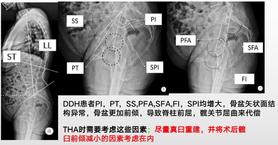 髋关节脱位快速诊治的关键技巧，此文必看！