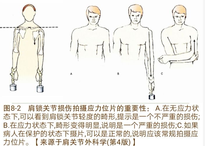 基础必学：肩锁关节脱位诊治要点及常用技术！