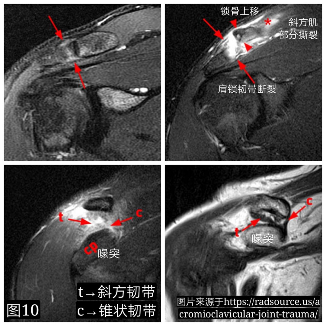 基础必学：肩锁关节脱位诊治要点及常用技术！