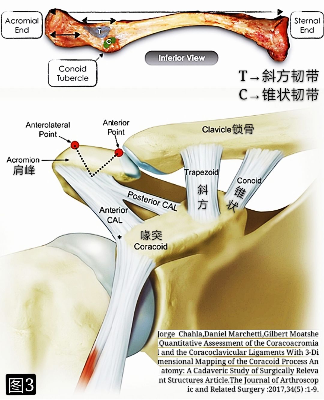 基础必学：肩锁关节脱位诊治要点及常用技术！