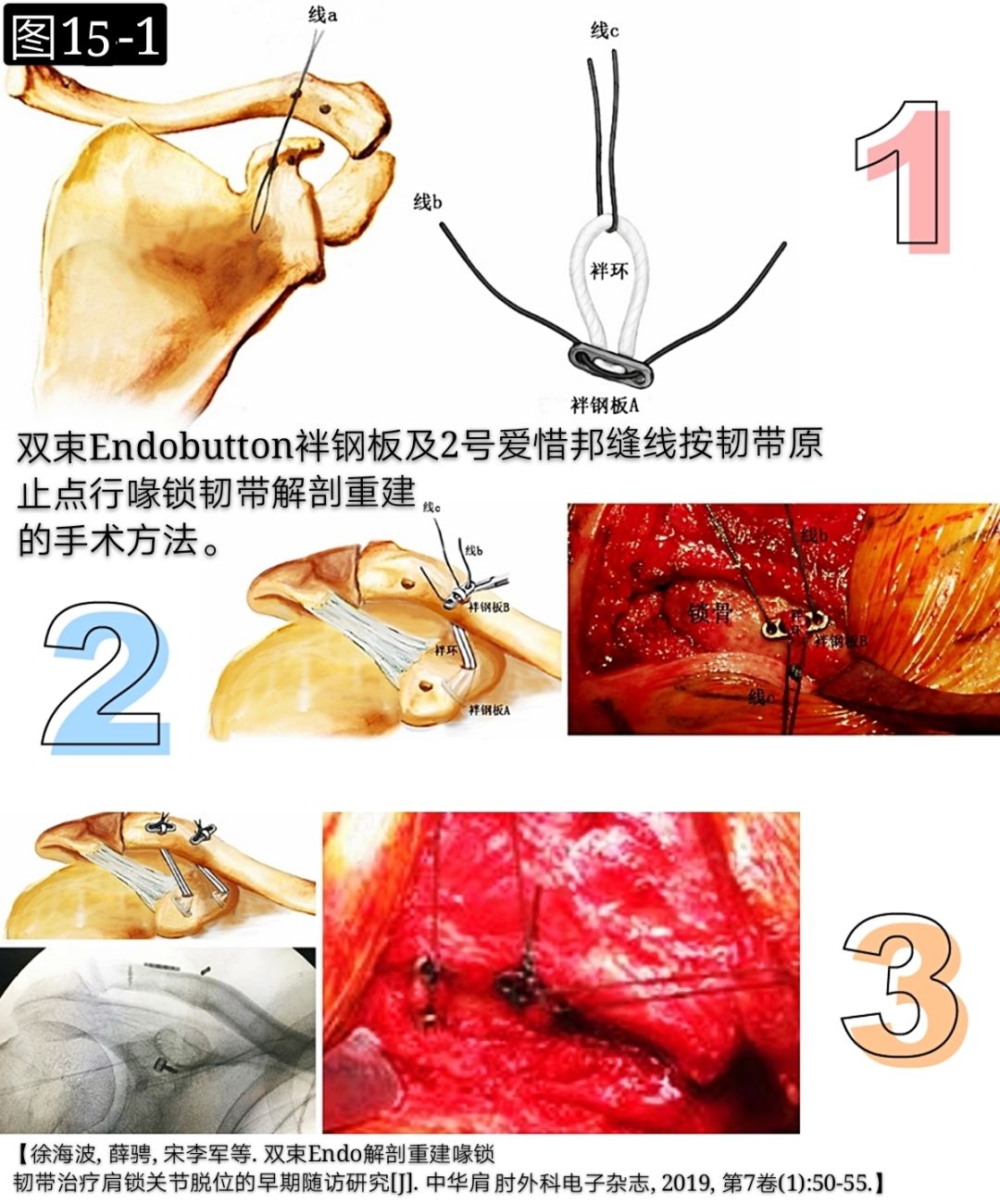 基础必学：肩锁关节脱位诊治要点及常用技术！