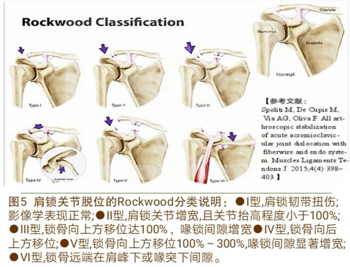 基础必学：肩锁关节脱位诊治要点及常用技术！