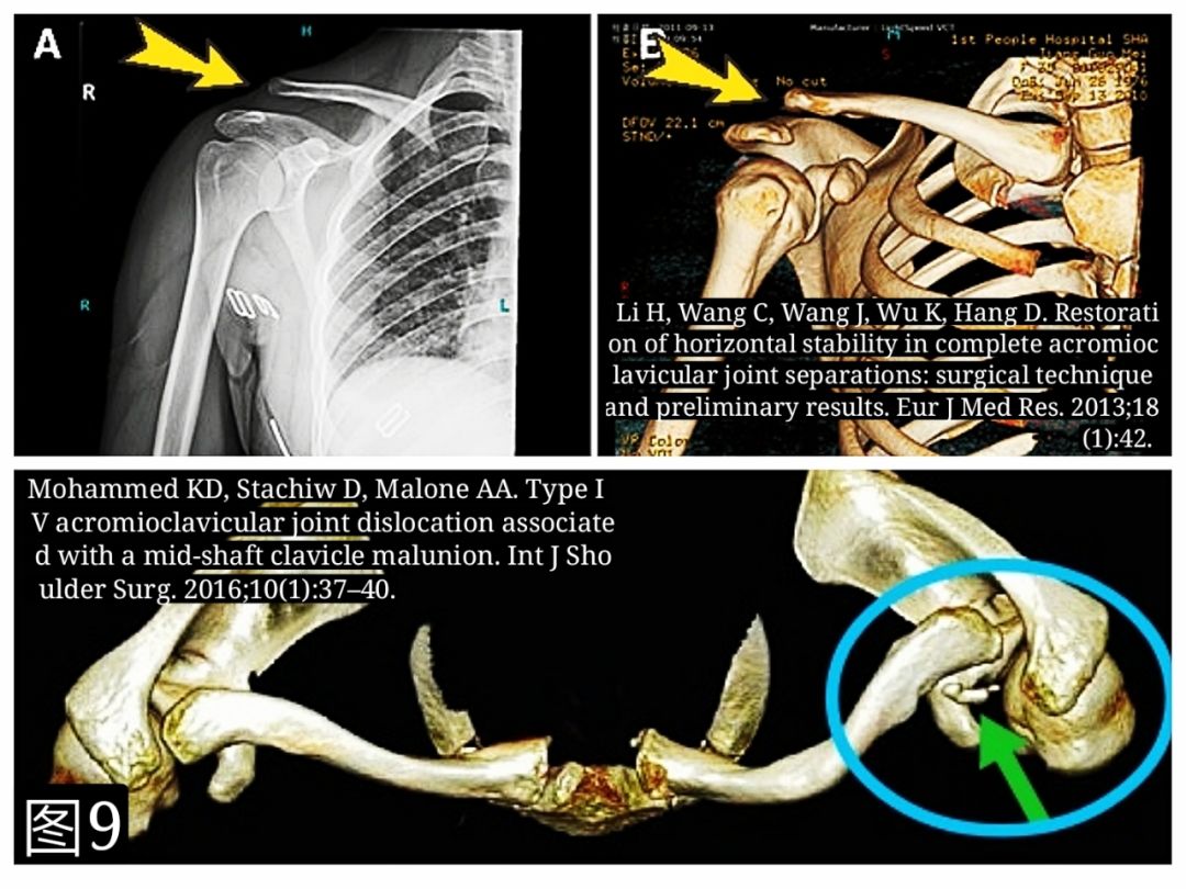 基础必学：肩锁关节脱位诊治要点及常用技术！