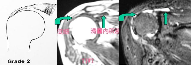 不同视角快速掌握肩袖损伤诊治要点，此文必看！