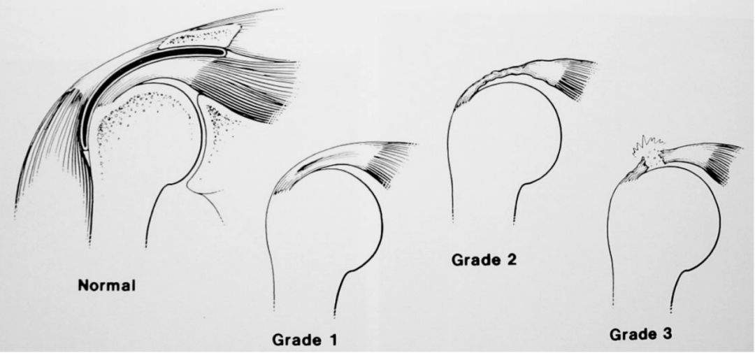 不同视角快速掌握肩袖损伤诊治要点，此文必看！