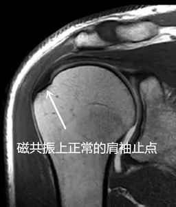 不同视角快速掌握肩袖损伤诊治要点，此文必看！