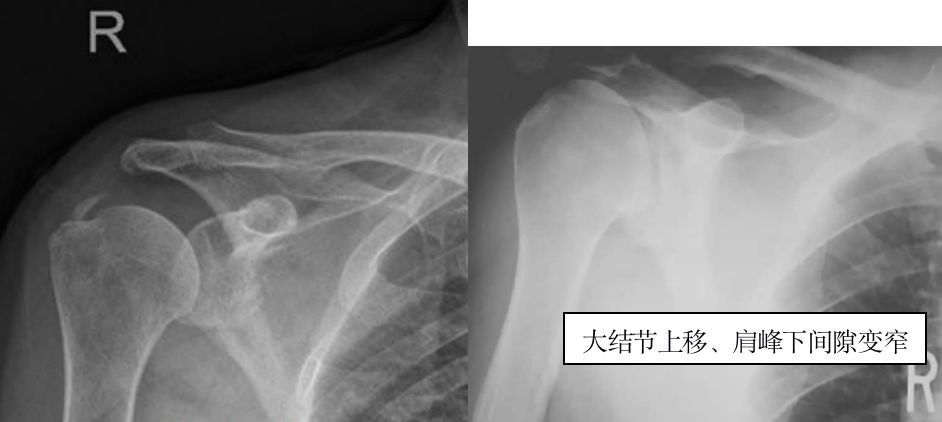 不同视角快速掌握肩袖损伤诊治要点，此文必看！