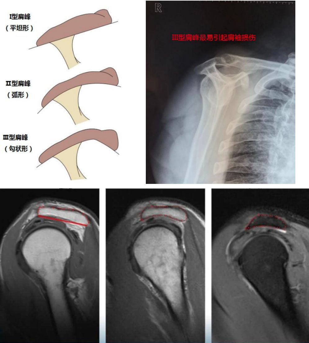 不同视角快速掌握肩袖损伤诊治要点，此文必看！