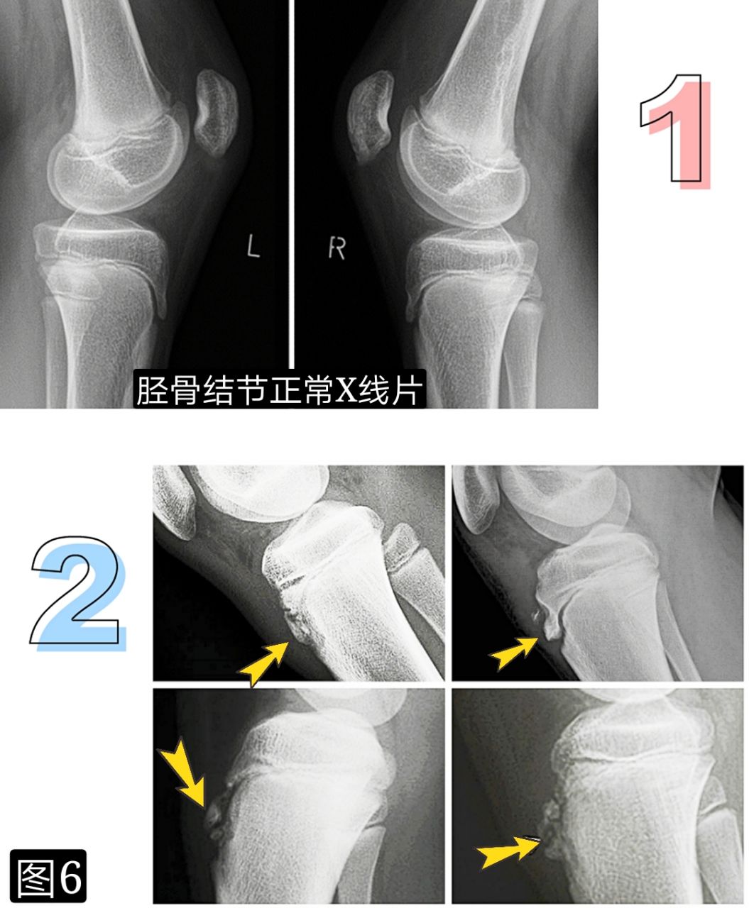 引起膝前痛的胫骨结节骨软骨炎，你会诊治吗?