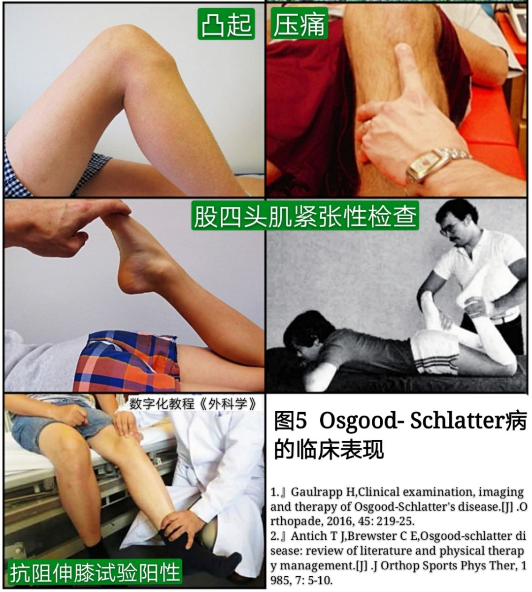 引起膝前痛的胫骨结节骨软骨炎，你会诊治吗?