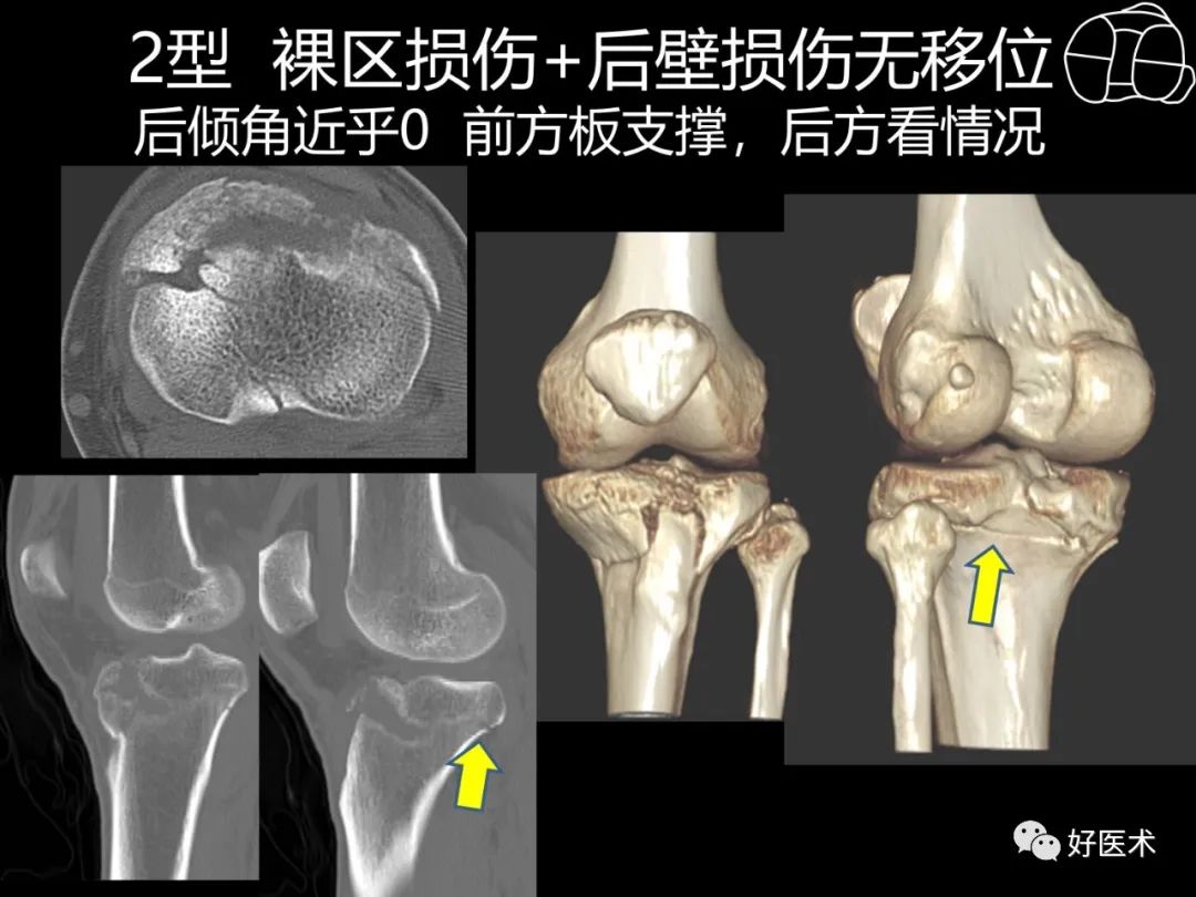 详解过伸型胫骨平台骨折新分型！