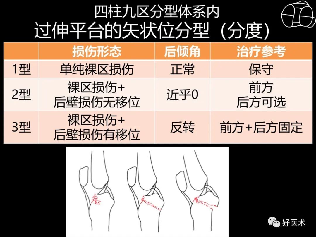 详解过伸型胫骨平台骨折新分型！
