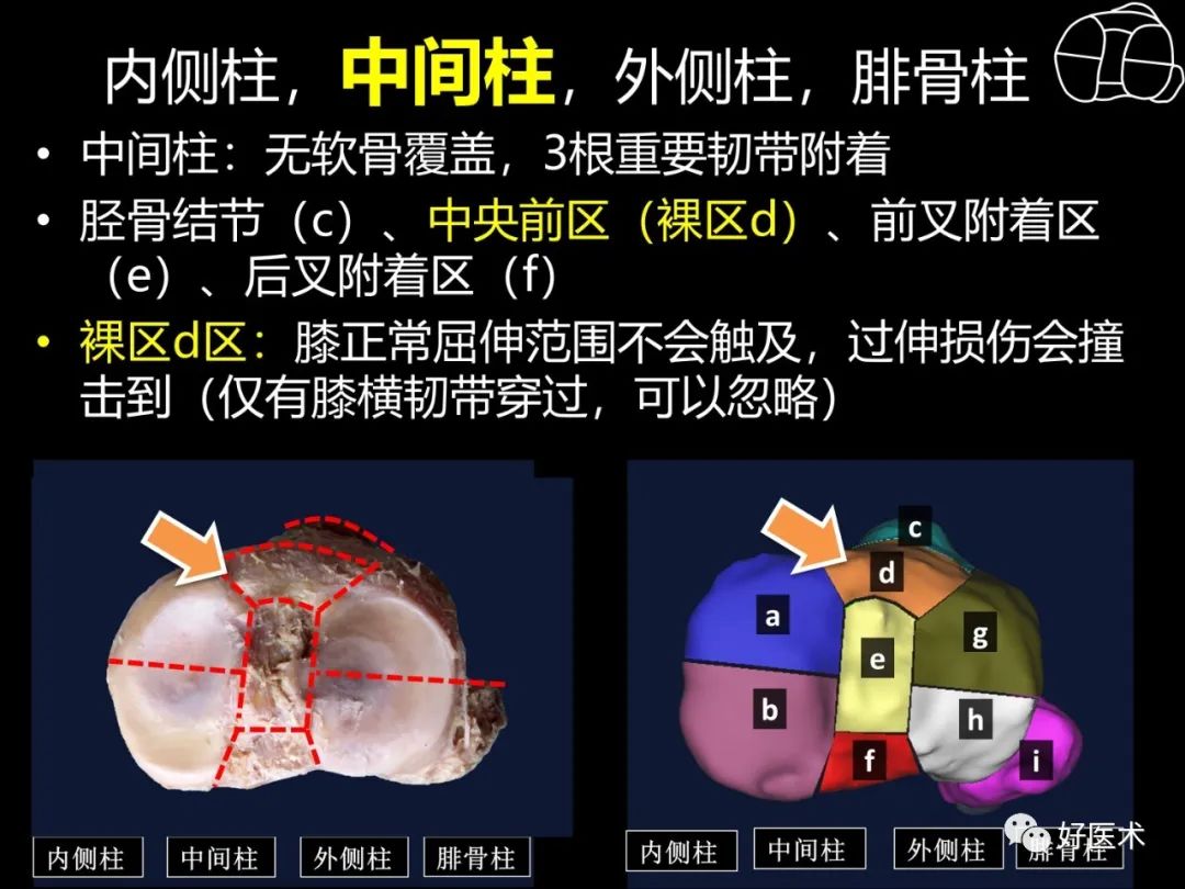 详解过伸型胫骨平台骨折新分型！