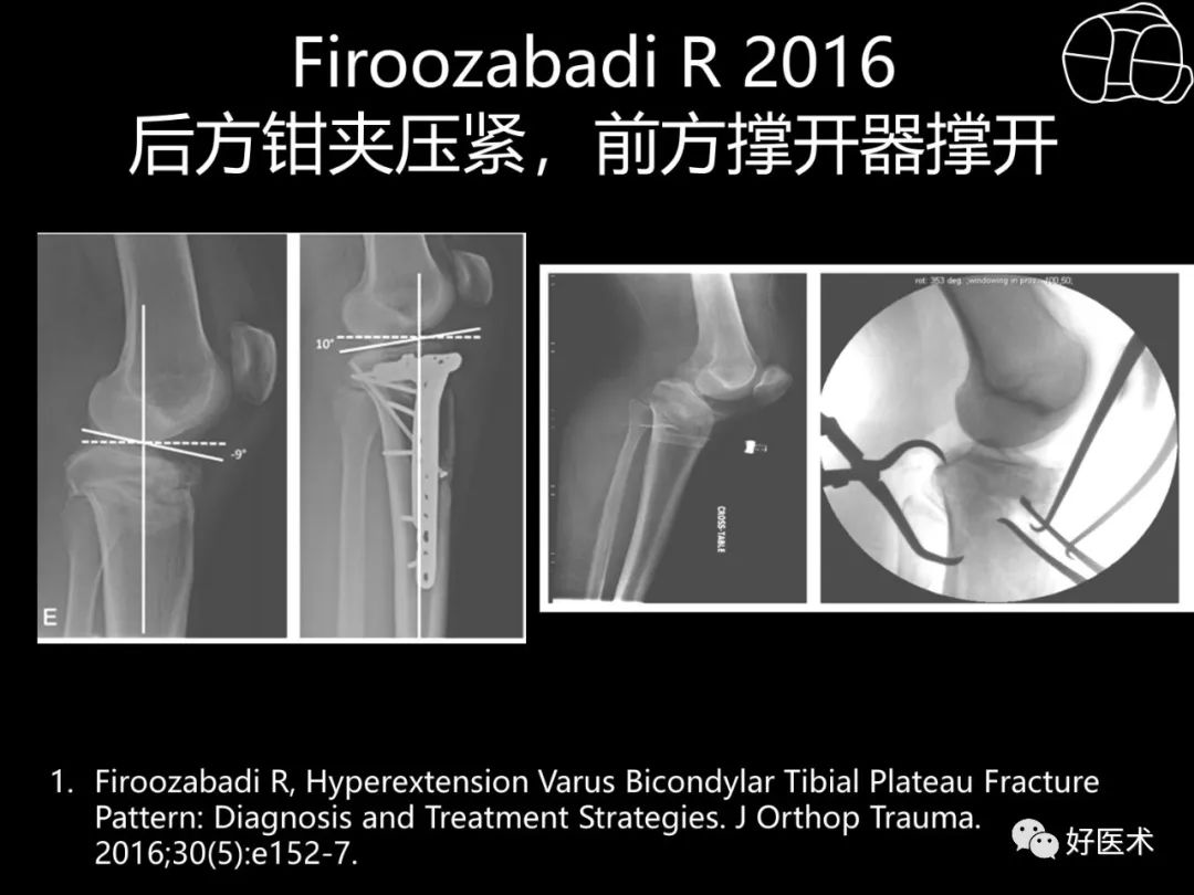 详解过伸型胫骨平台骨折新分型！