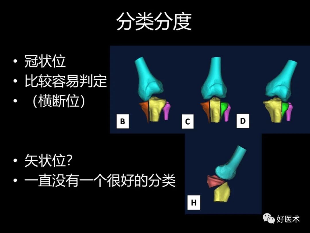 详解过伸型胫骨平台骨折新分型！