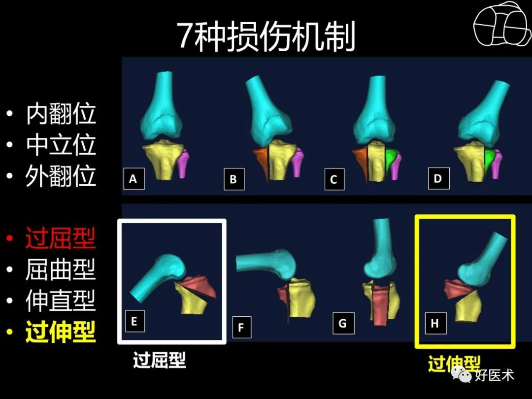 详解过伸型胫骨平台骨折新分型！