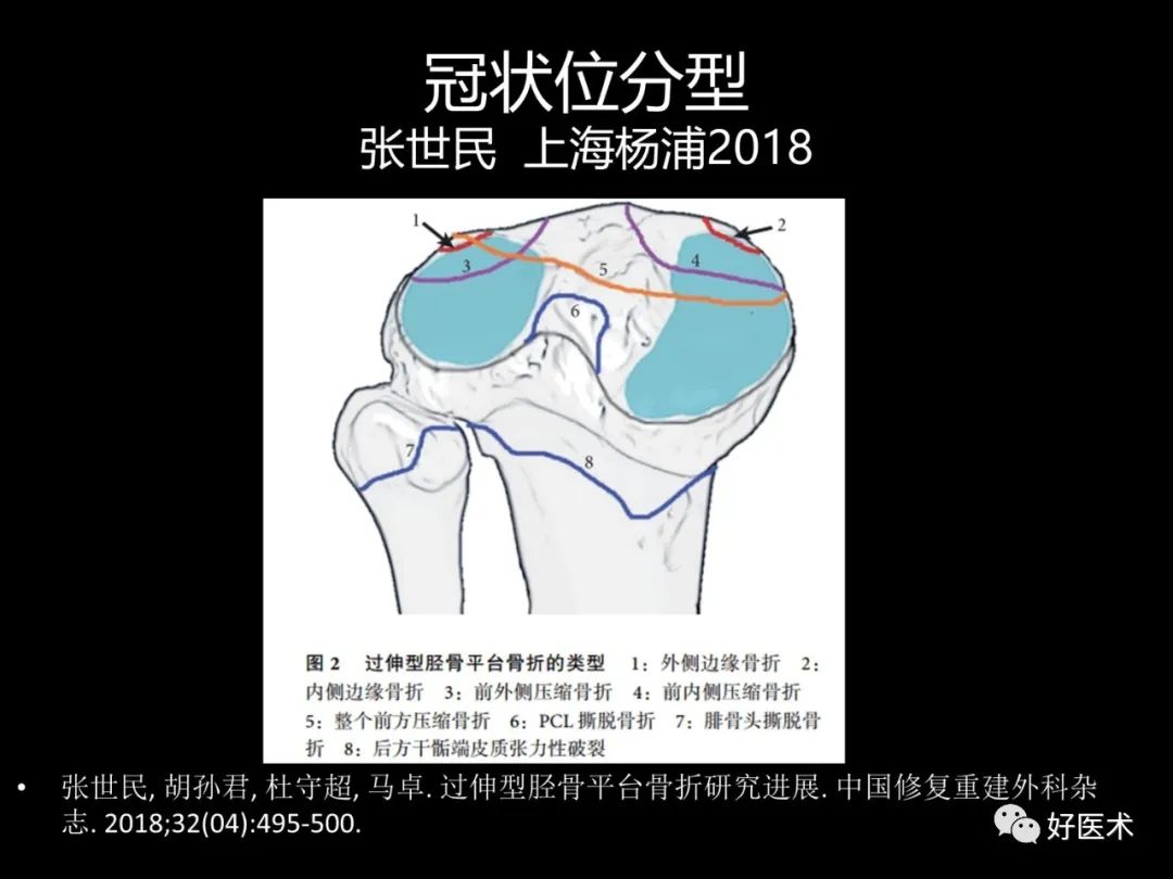 详解过伸型胫骨平台骨折新分型！