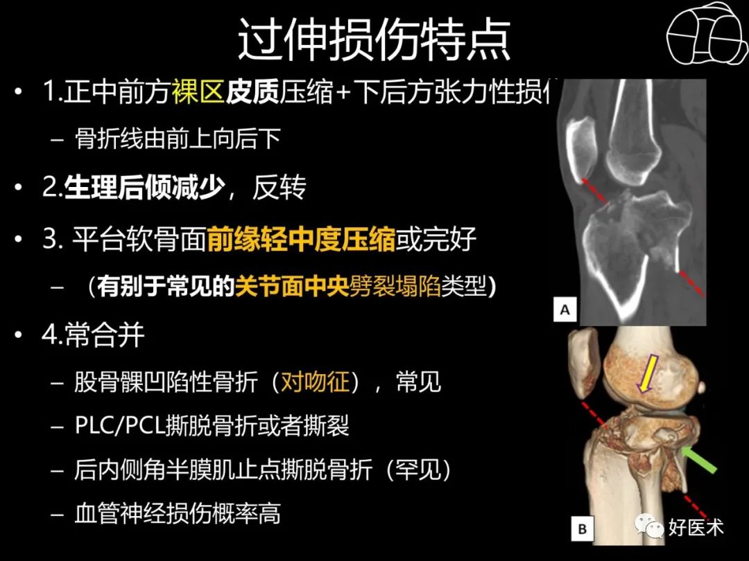 详解过伸型胫骨平台骨折新分型！