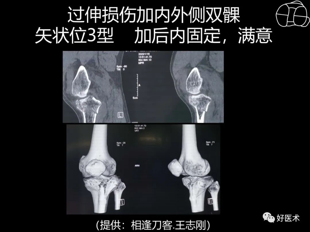 详解过伸型胫骨平台骨折新分型！