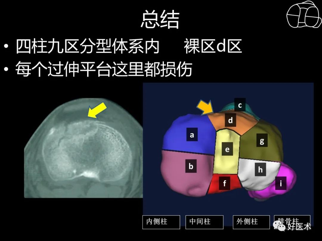 详解过伸型胫骨平台骨折新分型！