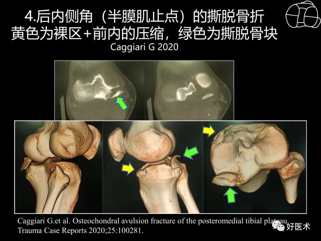 详解过伸型胫骨平台骨折新分型！