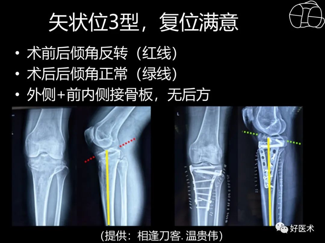 详解过伸型胫骨平台骨折新分型！