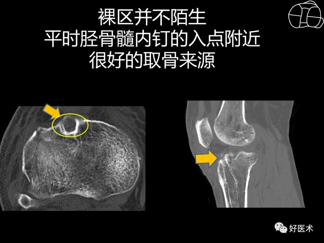 详解过伸型胫骨平台骨折新分型！