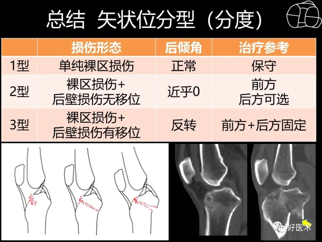 详解过伸型胫骨平台骨折新分型！