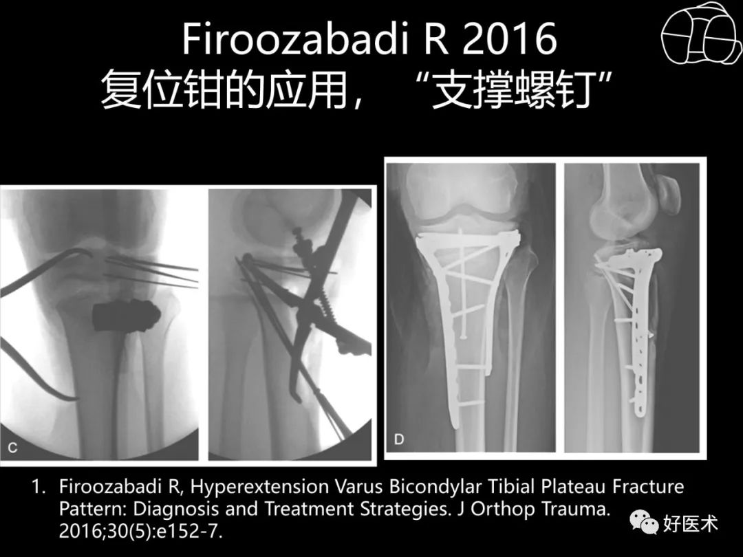 详解过伸型胫骨平台骨折新分型！