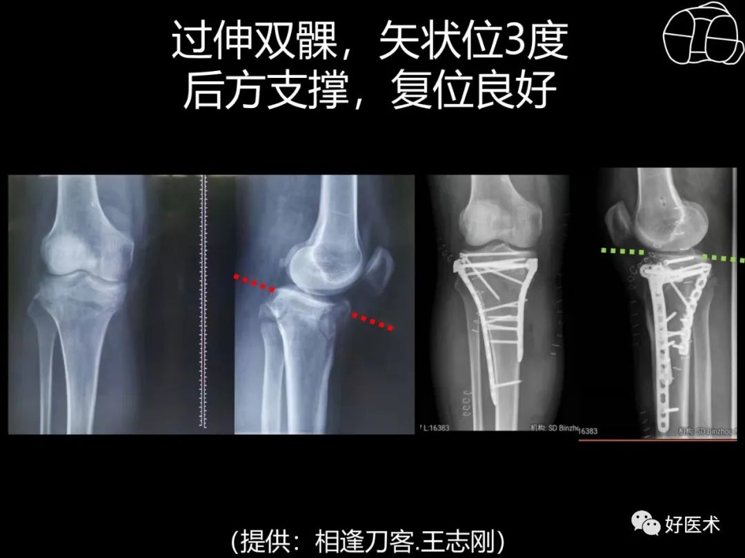 详解过伸型胫骨平台骨折新分型！