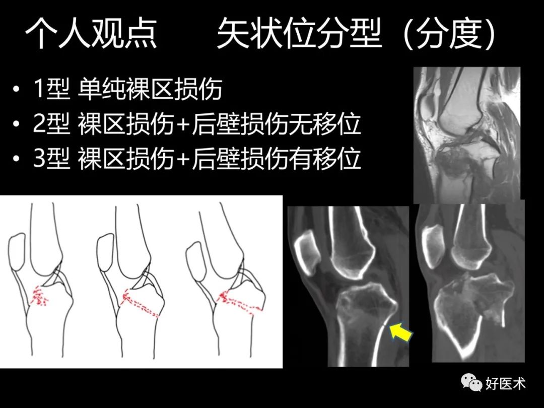 详解过伸型胫骨平台骨折新分型！