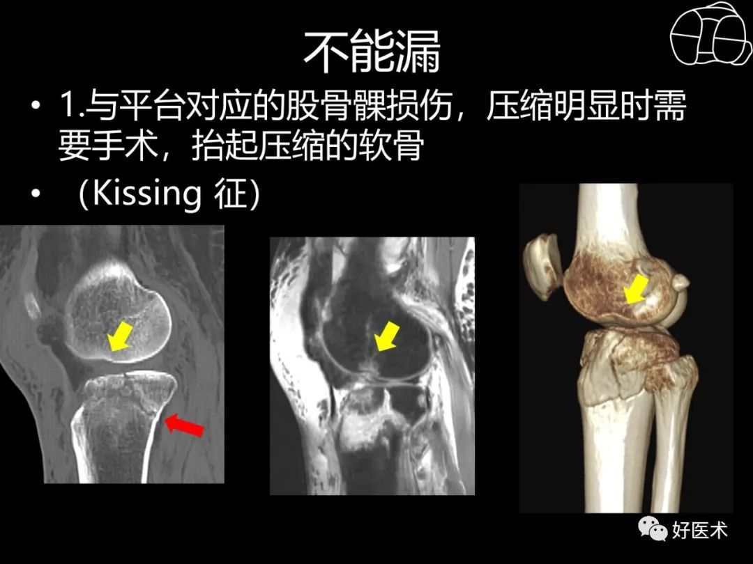 详解过伸型胫骨平台骨折新分型！