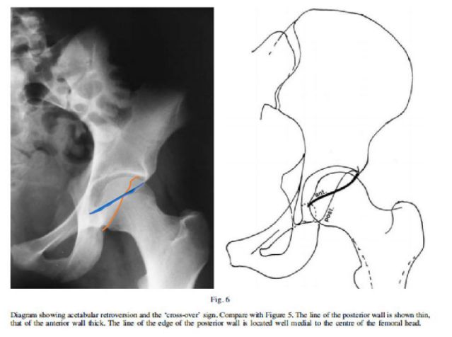 如何从影像学判断髋臼后倾？这一招一定要学会！
