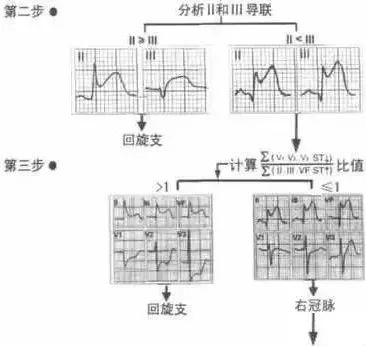 三步快速判读心肌梗死定位！