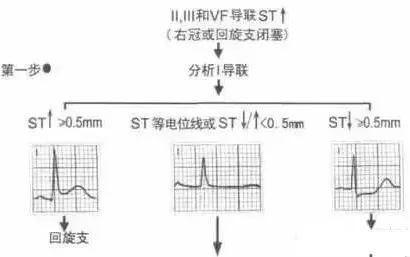 三步快速判读心肌梗死定位！