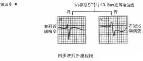 三步快速判读心肌梗死定位！