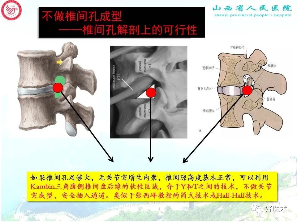 椎间孔解剖及PTED椎间孔成型技术—按需成型五级法！