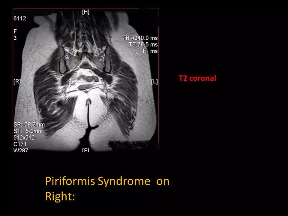 图文详解梨状肌综合征MR表现及诊治技巧，值得推荐！