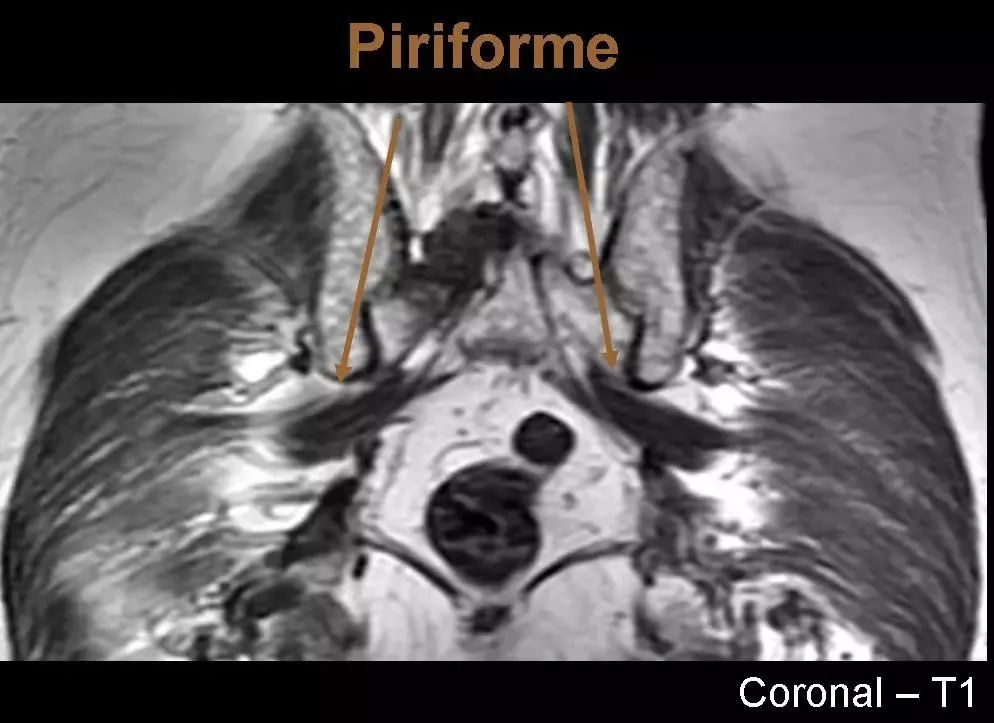 图文详解梨状肌综合征MR表现及诊治技巧，值得推荐！