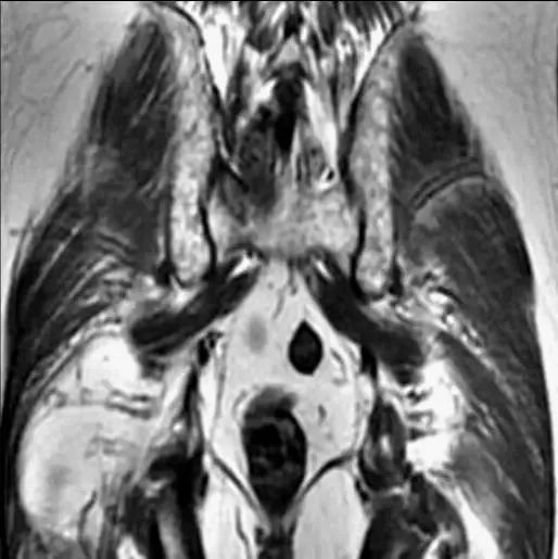 图文详解梨状肌综合征MR表现及诊治技巧，值得推荐！