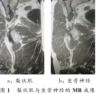 图文详解梨状肌综合征MR表现及诊治技巧，值得推荐！