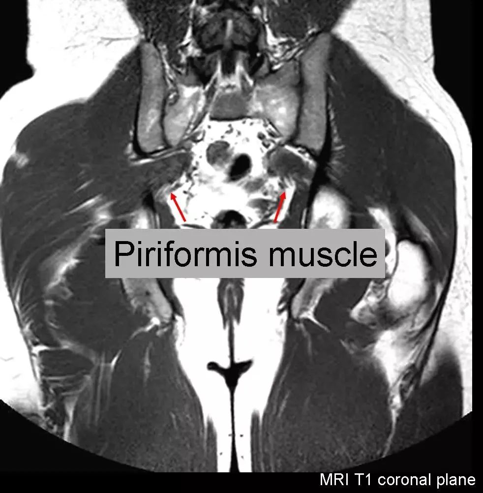 图文详解梨状肌综合征MR表现及诊治技巧，值得推荐！