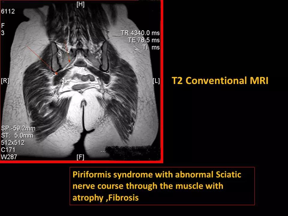 图文详解梨状肌综合征MR表现及诊治技巧，值得推荐！
